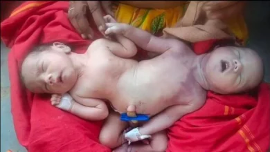 कैमरे के लेंस से Birth of a unique twin baby with two heads and four arms.