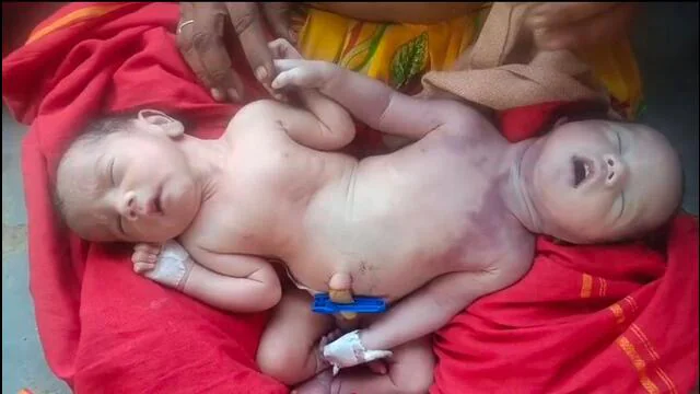कैमरे के लेंस से Birth of a unique twin baby with two heads and four arms.