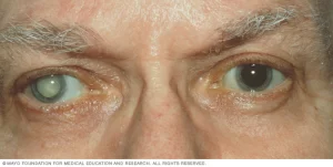 मोतिया बिन्द का उपचार डॉक्टर की सलाह से 2 Health & Fitness Cataract treatment under a doctor's advice.